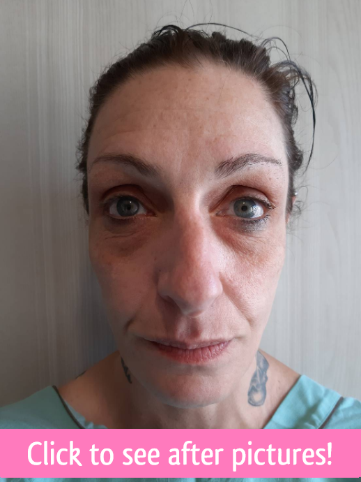 click to see paula nose