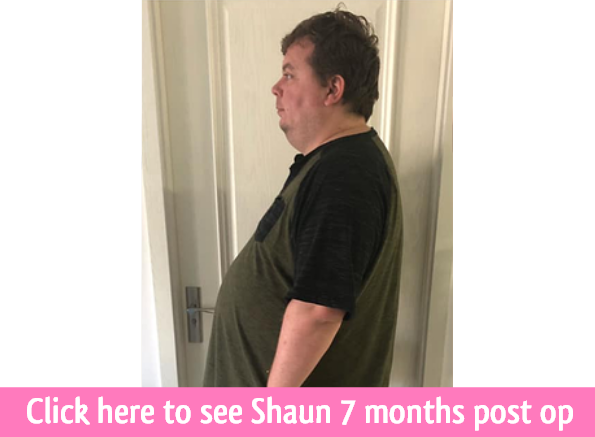 click to see shaun 7 months post op gastric sleeve