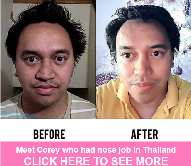 corey nose job thailand