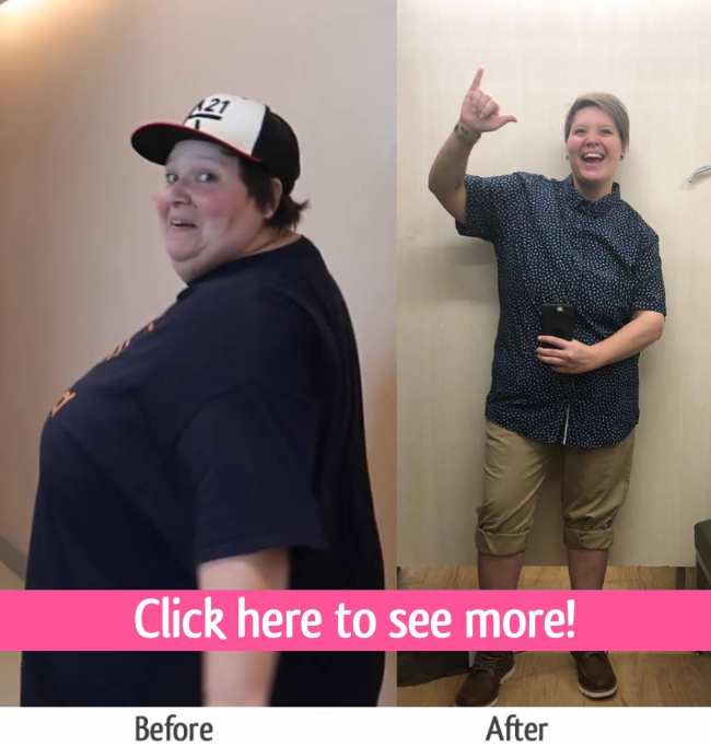 emily gastric sleeve