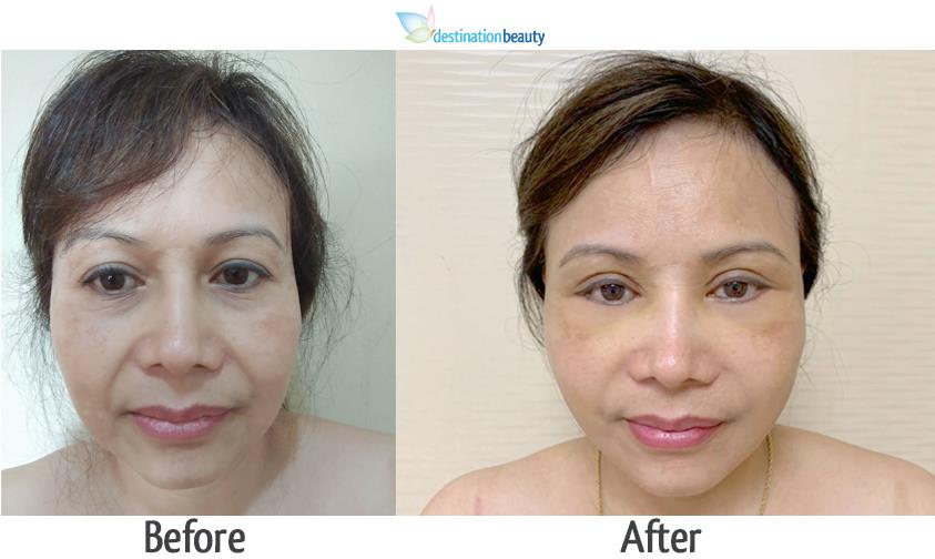 face lift and eyelid surgery thailand (2)