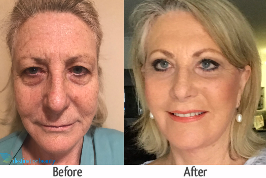 face lift eyelid surgery chin lift