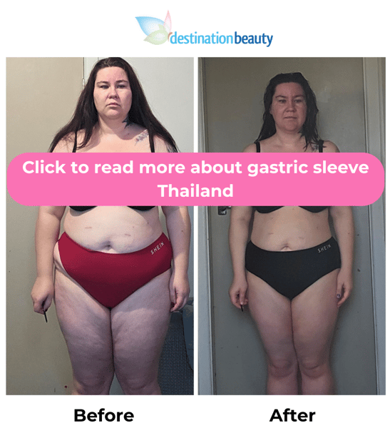 gastric sleeve thailand