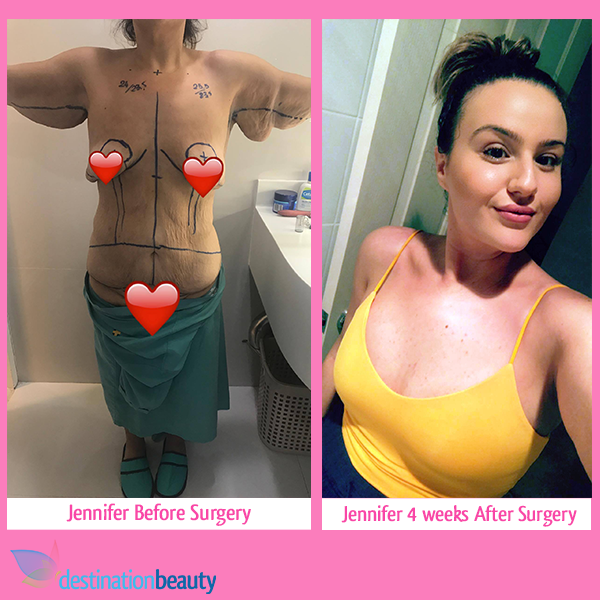 Jennifer's before and after skin removal thailand