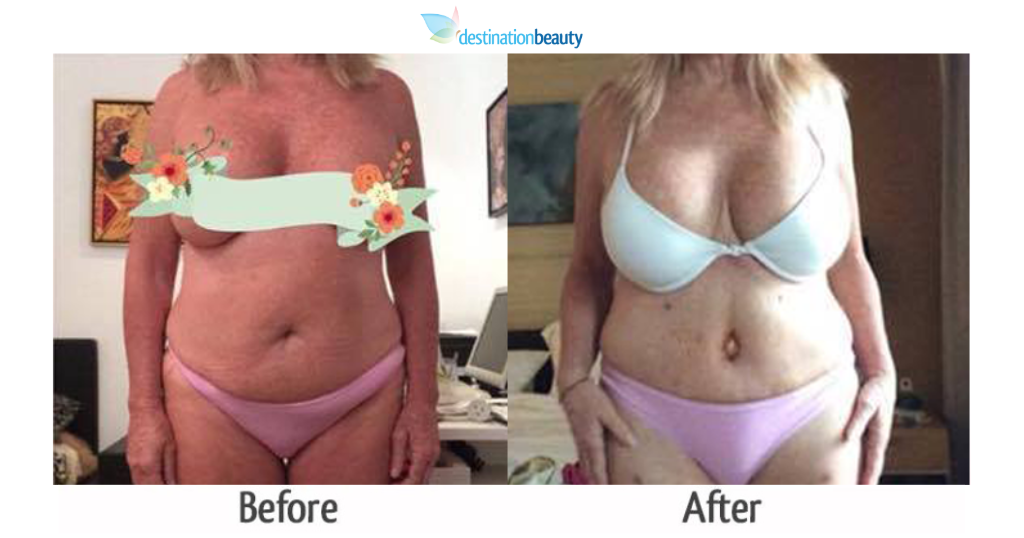 kandis_liposuction_tummy tuck_dr_ring