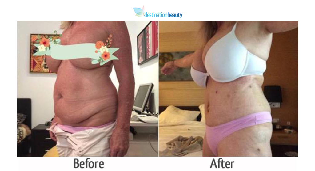 kandis_liposuction_tummy tuck_dr_ring2