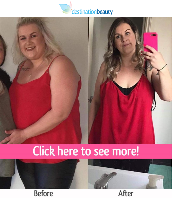 katie weight loss surgery