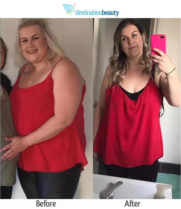 katie weight loss surgery