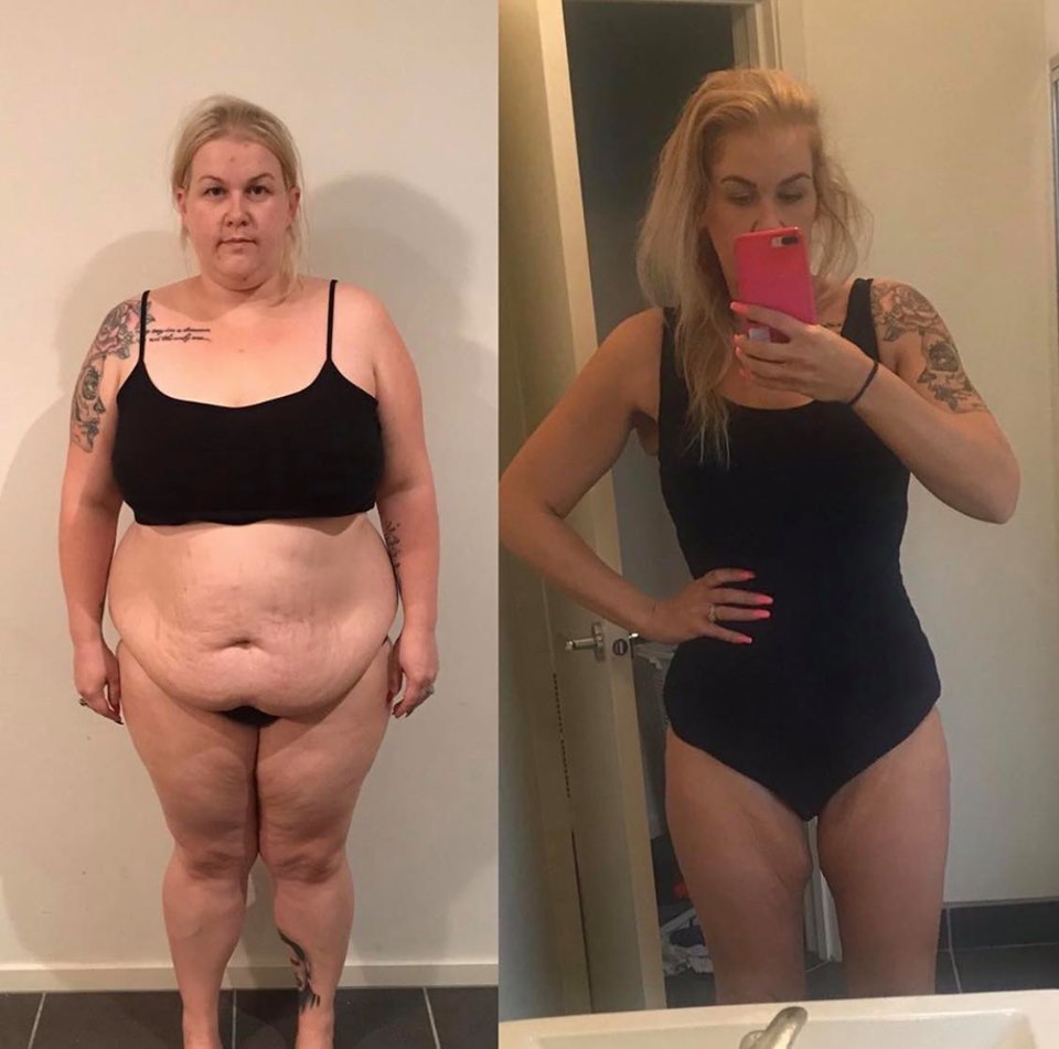 katie wls 10 months post op 2-1