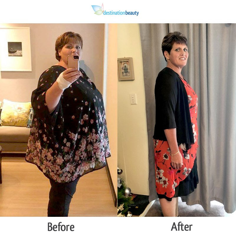 kimmy lost 58 kgs 6 months after gastric sleeve