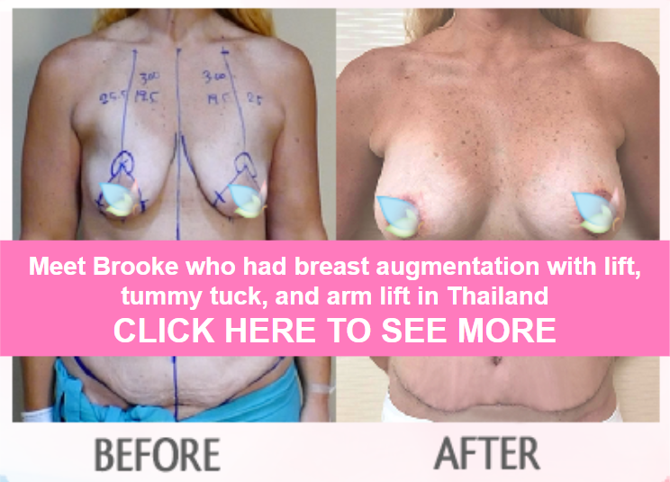 meet brooke who had mummy makeover in thailand
