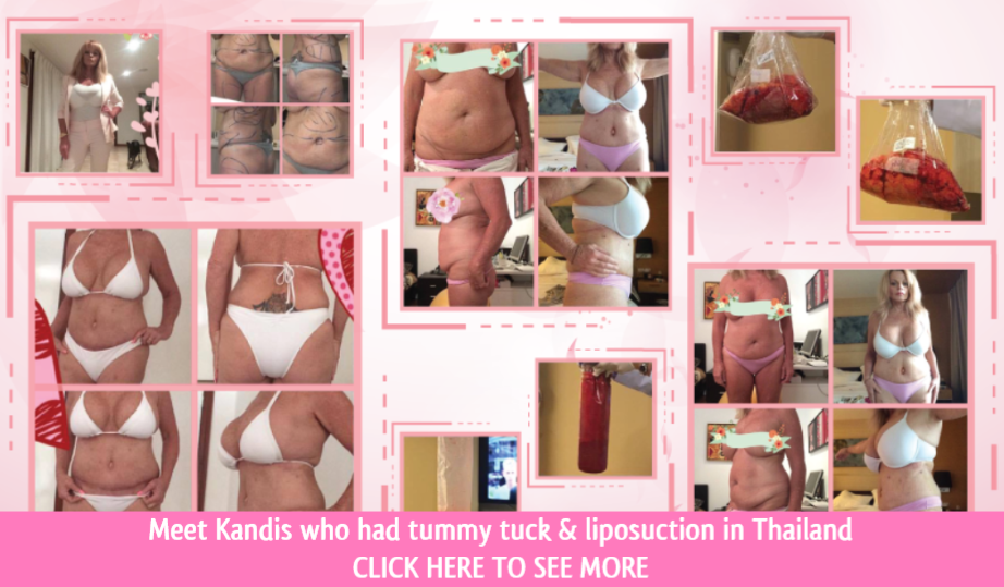 meet kandis tt lipo 2