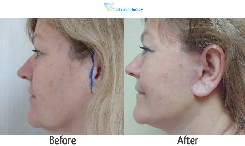 mid face and neck lift 3