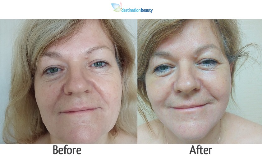 mid face and neck lift