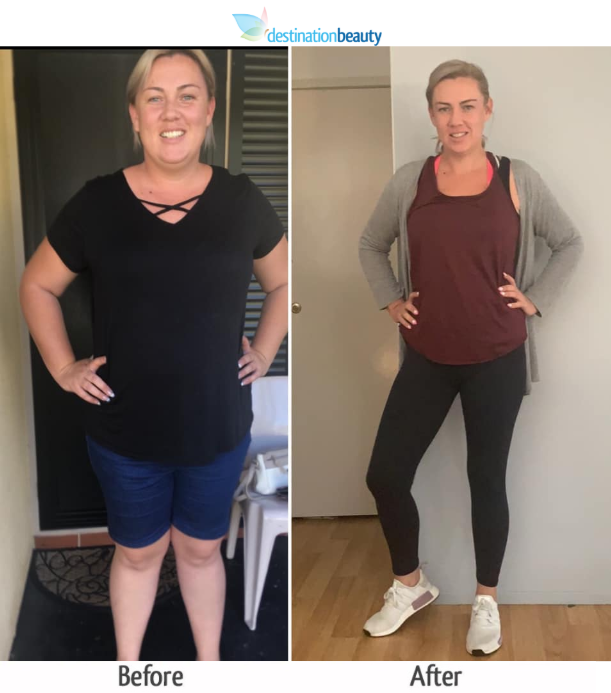 paula lost 47 kgs 8 months after gastric sleeve update