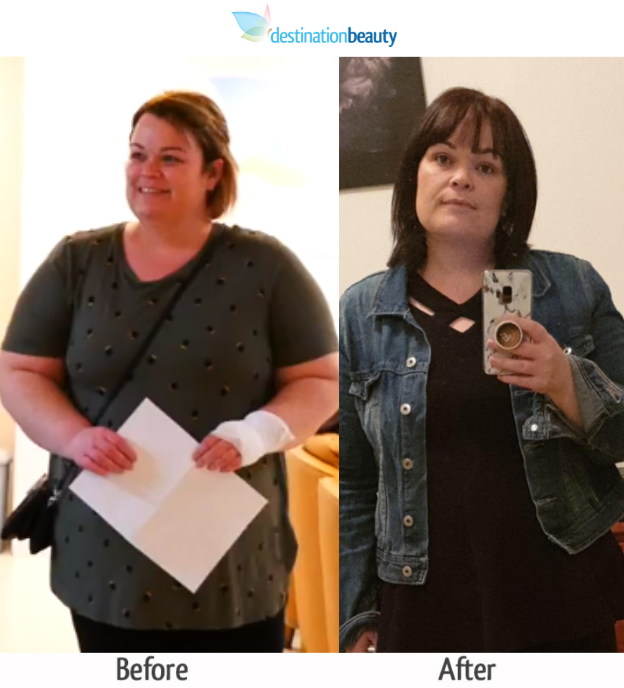 rebecca's before and after gastric sleeve