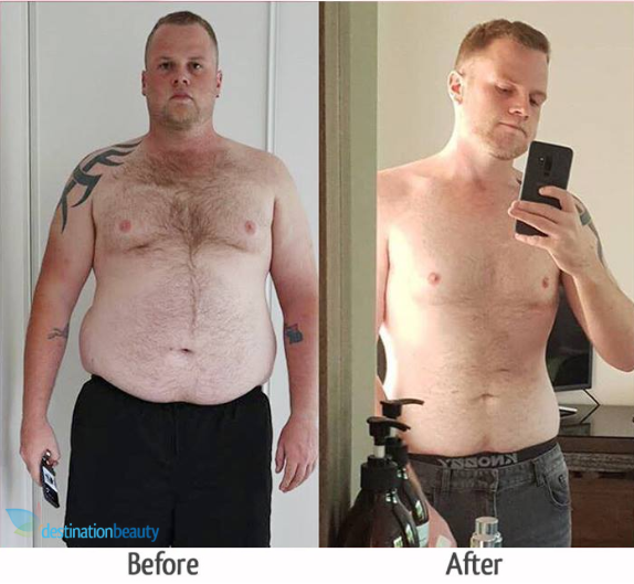 reece before and after gastric sleeve thailand