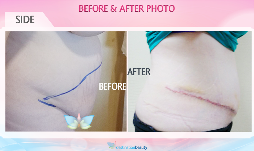 tummy tuck recovery stories