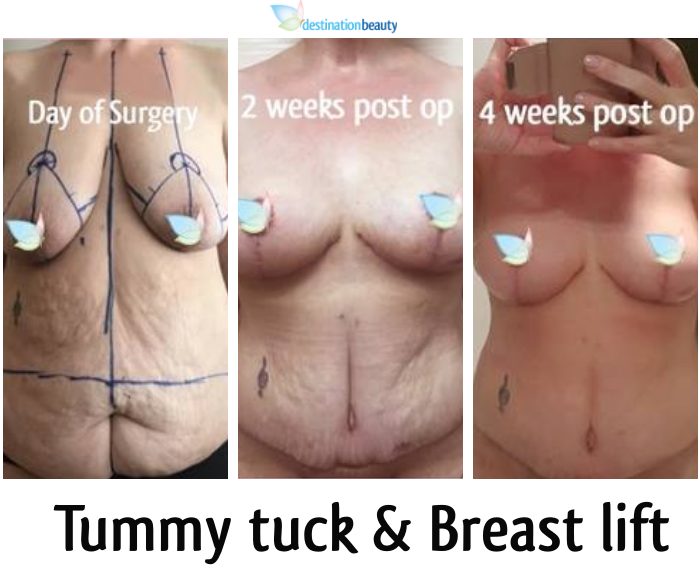 tummy tuck and breast lift thailand