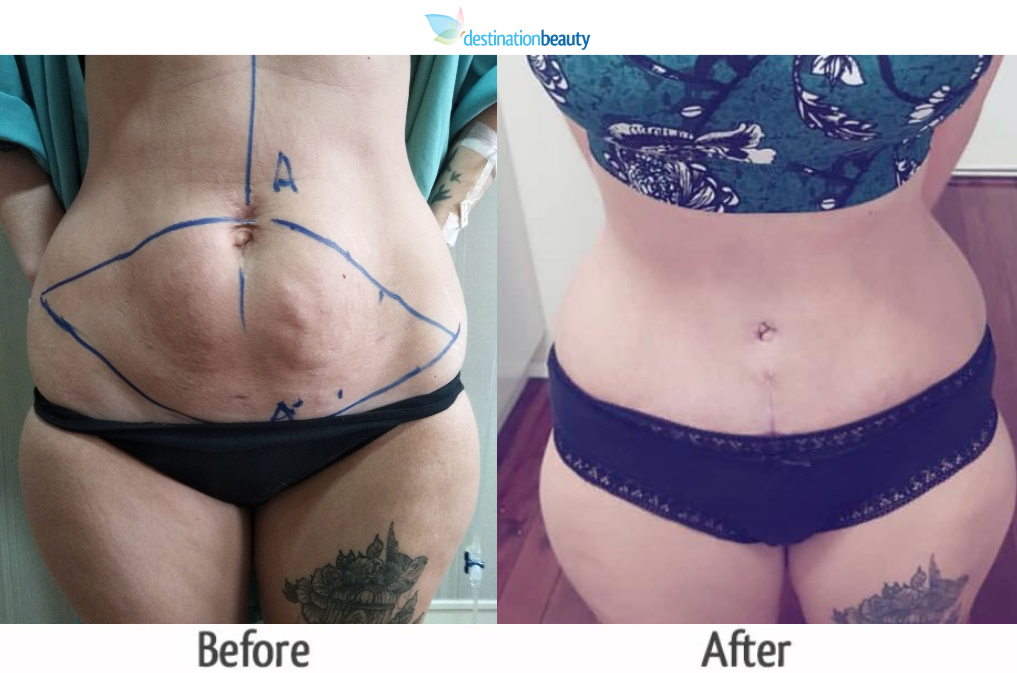 tummy tuck thailand 