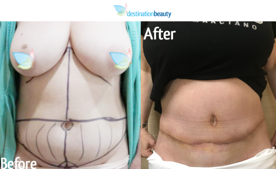 tummy tuck thailand-3