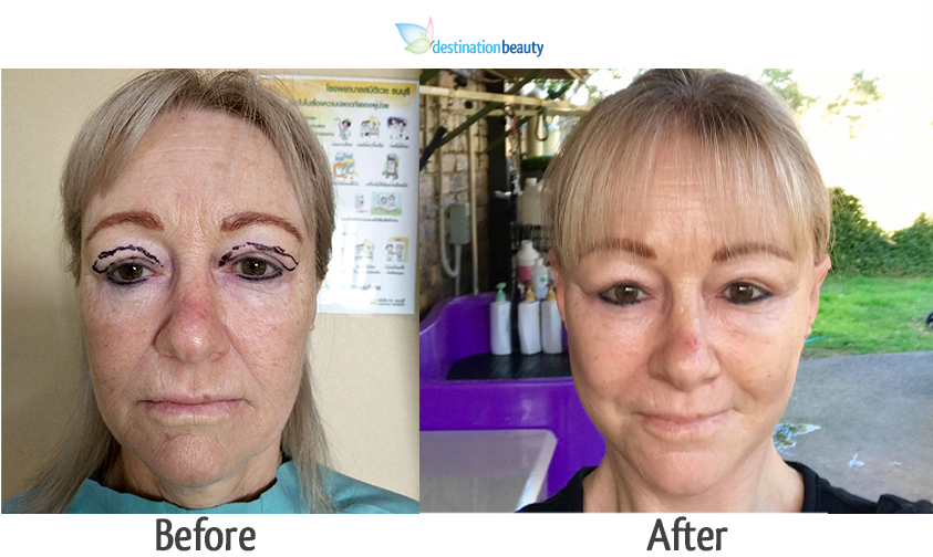 Kellie looks 10 years younger after face lift in Thailand