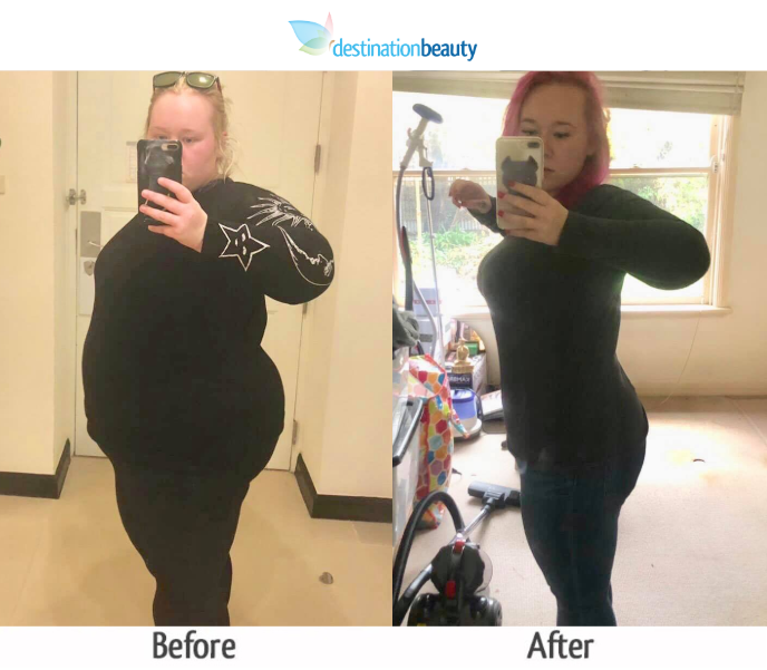 Gastric sleeve surgery in Thailand Jessica lost 63 kgs 1 year after
